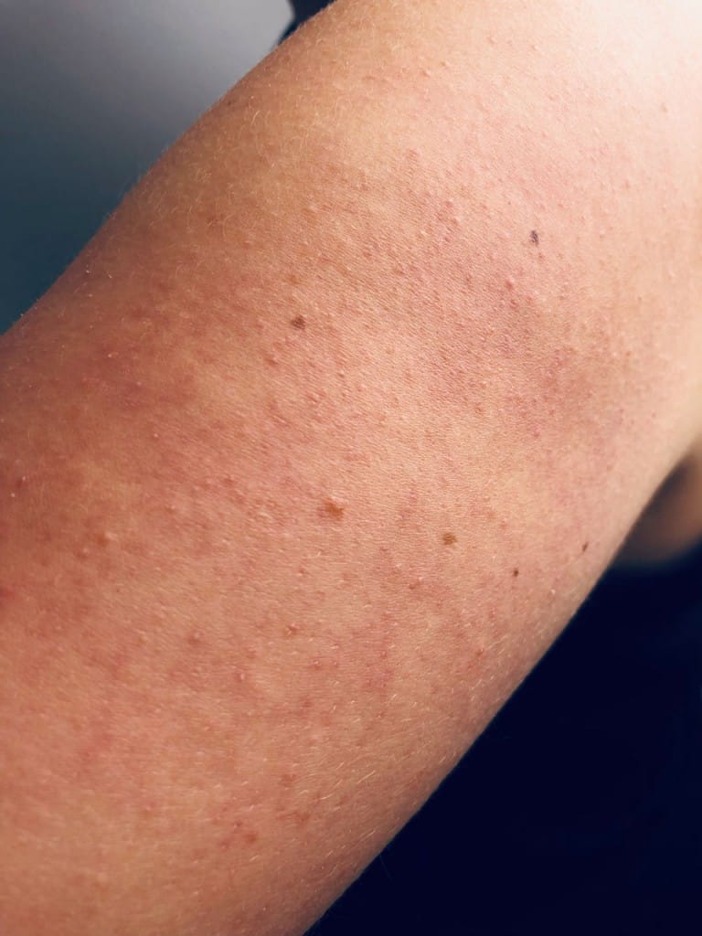 Reibeisenhaut: Erfahrung & 6 hilfreiche Tipps zur Behandlung