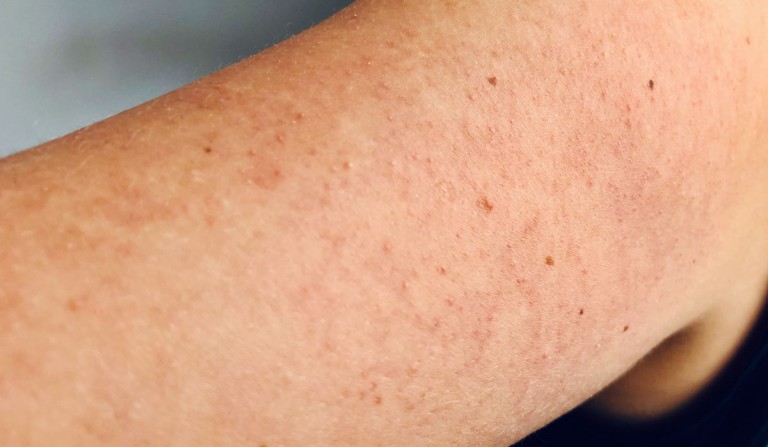 Reibeisenhaut, Keratosis Pilaris, Keratosis Pilaris Behandlung, Verhörnungsstörung, Pickel an den Oberarmen, Beauty Tipps, Hautpflege, ElisaZunder Blogazine,